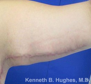 Arm Lift before and after photos by Hughes Plastic Surgery in Los Angeles, CA