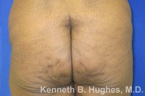 Butt Implants Case 5502 Before Photo