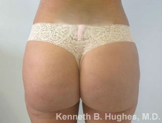 Butt Implants Case 5508 After Photo