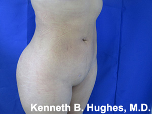 Brazilian Butt Lift, Liposuction before and after photo by Hughes Plastic Surgery in Los Angeles, CA