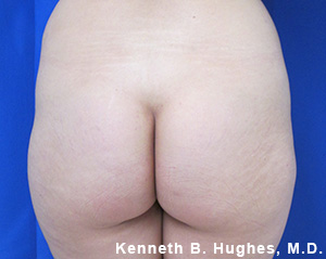 Butt Implants Case 5123 Before Photo
