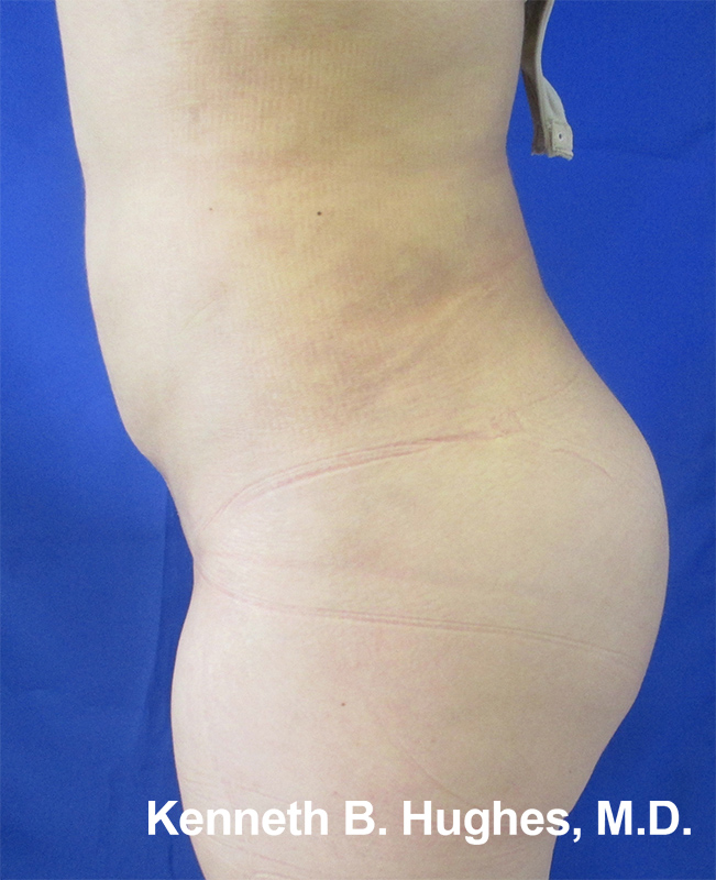 Butt Implants Case 5425 After Photo
