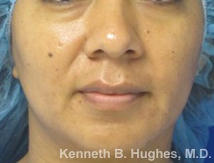 Facial Fat Grafting before and after photos by Hughes Plastic Surgery in Los Angeles, CA