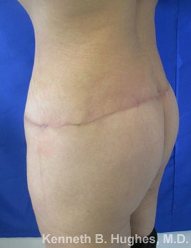 Liposuction Revision and Cellulite Reduction with Thigh Lift before and after photos by Hughes Plastic Surgery in Los Angeles, CA