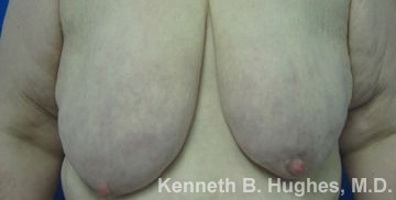 Breast Augmentation and Lift before and after photos by Hughes Plastic Surgery in Los Angeles, CA
