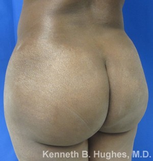 Brazilian Butt Lift, Liposuction before and after photo by Hughes Plastic Surgery in Los Angeles, CA