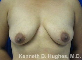 Breast Augmentation (Implants) before and after photo by Hughes Plastic Surgery in Los Angeles, CA