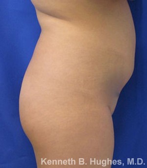 Liposuction, Butt Implants before and after photo by Hughes Plastic Surgery in Los Angeles, CA