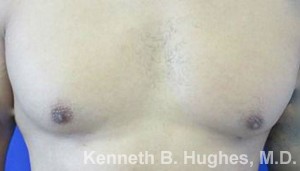 Male Gynecomastia before and after photos by Hughes Plastic Surgery in Los Angeles, CA