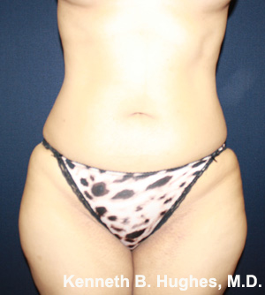 Brazilian Butt Lift, Liposuction, Butt Implants before and after photo by Hughes Plastic Surgery in Los Angeles, CA