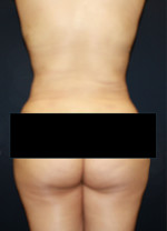 Brazilian Butt Lift for Thinner Patients