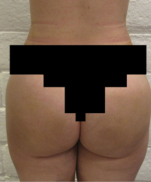 Brazilian Butt Lift for Thinner Patients before and after photo by Hughes Plastic Surgery in Los Angeles, CA