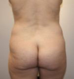 Brazilian Butt Lift for Thinner Patients