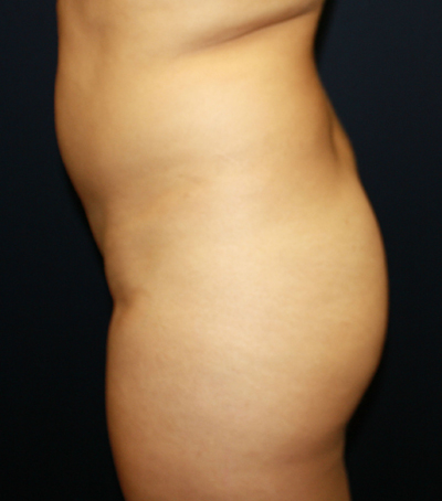 Brazilian Butt Lift before and after photo by Hughes Plastic Surgery in Los Angeles, CA