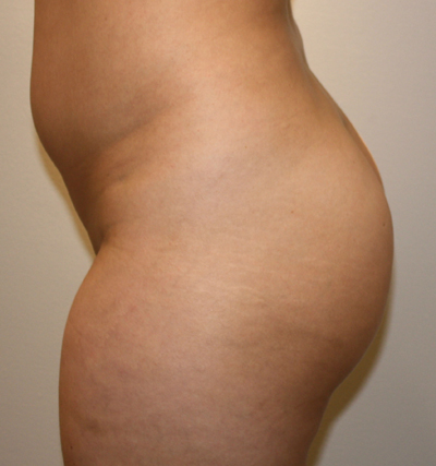 Brazilian Butt Lift for Thinner Patients before and after photo by Hughes Plastic Surgery in Los Angeles, CA