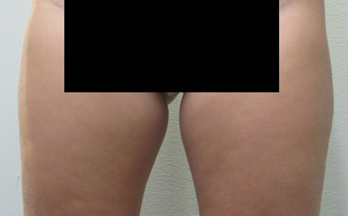 Inner Thighs before and after photo by Hughes Plastic Surgery in Los Angeles, CA