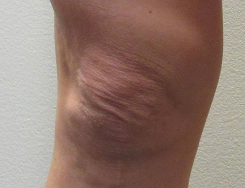 Knee before and after photos by Hughes Plastic Surgery in Los Angeles, CA