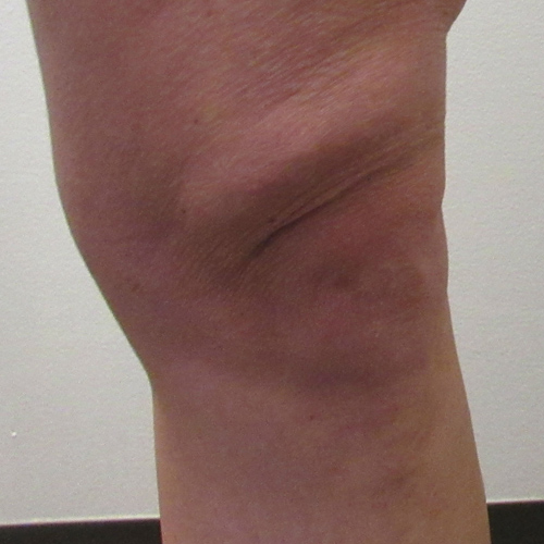Knee before and after photos by Hughes Plastic Surgery in Los Angeles, CA
