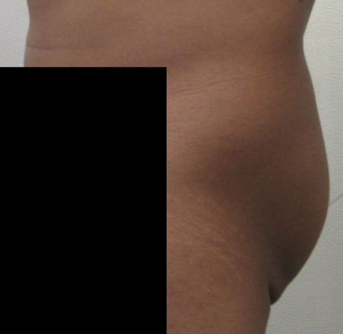 Butt Implants Case 7566 Before Photo