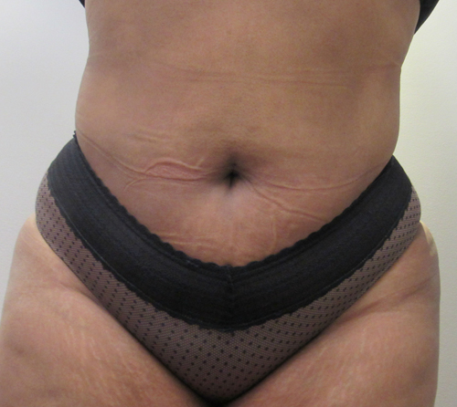 Abdomen before and after photos by Hughes Plastic Surgery in Los Angeles, CA