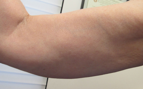 Arms before and after photo by Hughes Plastic Surgery in Los Angeles, CA