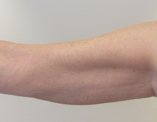Arms before and after photo by Hughes Plastic Surgery in Los Angeles, CA