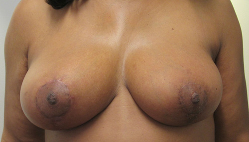 Breast Reduction before and after photos by Hughes Plastic Surgery in Los Angeles, CA
