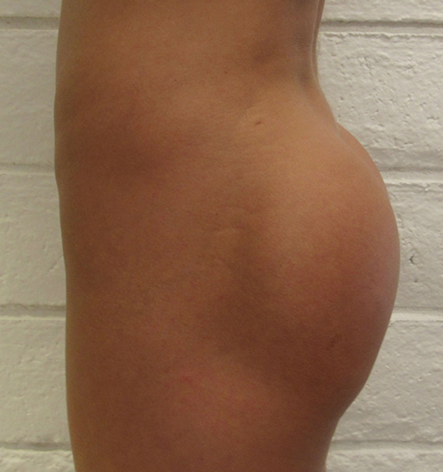 Butt Implants Case 7724 Before Photo