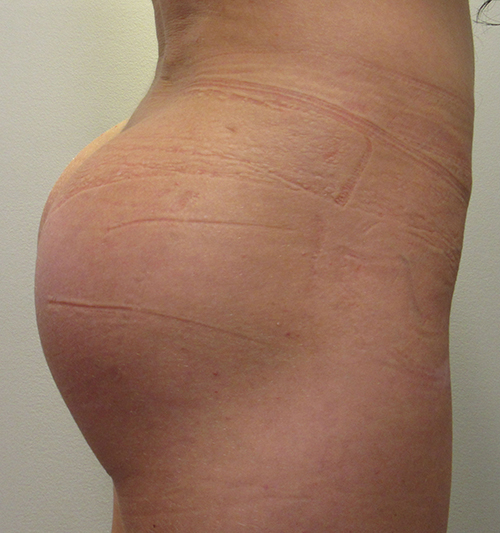 Butt Implants Case 7724 Before Photo