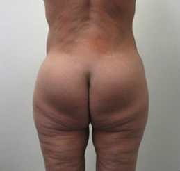 Butt Implants Case 7815 Before Photo