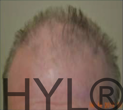 PRP for hair loss before and after photos by Hughes Plastic Surgery in Los Angeles, CA
