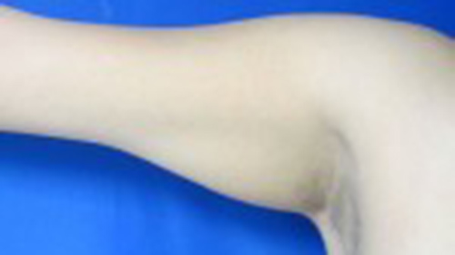 Liposuction, Arms before and after photo by Hughes Plastic Surgery in Los Angeles, CA