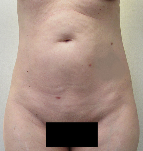 BodyTite, Liposuction before and after photo by Hughes Plastic Surgery in Los Angeles, CA