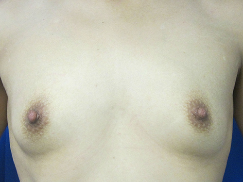 Breast Augmentation before and after photo by Hughes Plastic Surgery in Los Angeles, CA