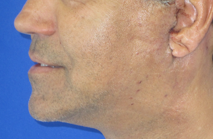 Male Neck Lift before and after photos by Hughes Plastic Surgery in Los Angeles, CA