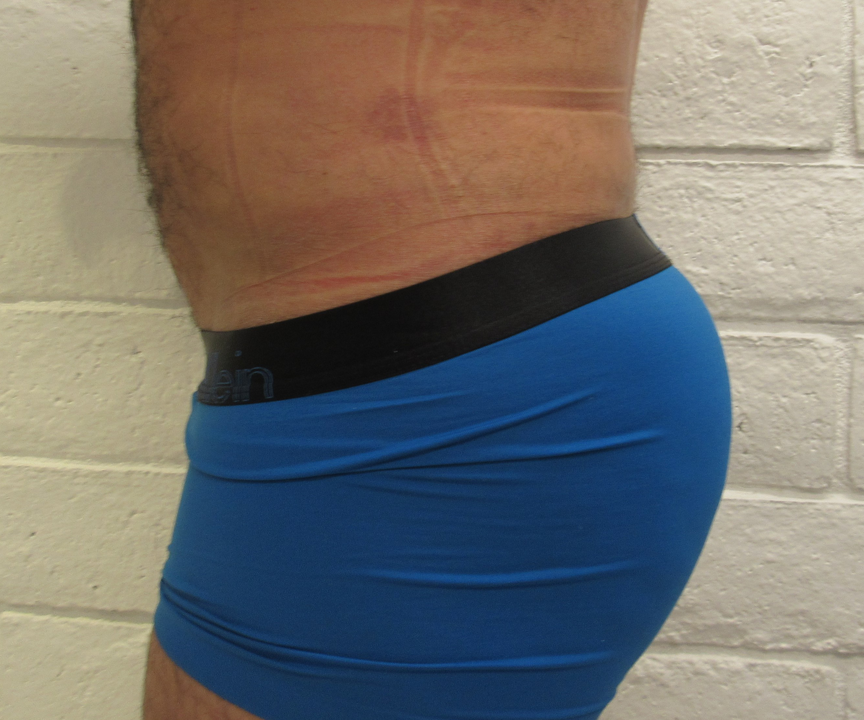 Male Liposuction before and after photos by Hughes Plastic Surgery in Los Angeles, CA