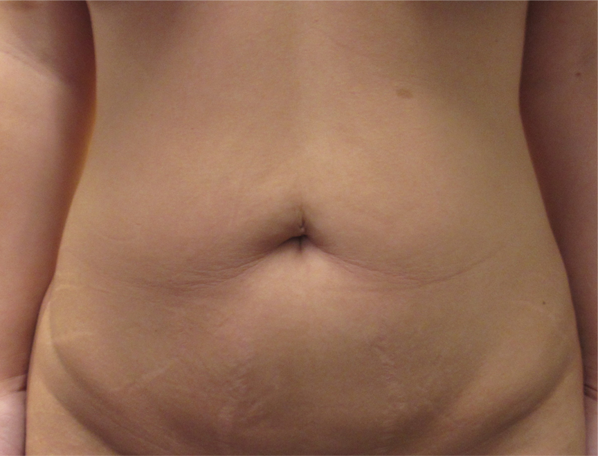 Abdomen before and after photos by Hughes Plastic Surgery in Los Angeles, CA
