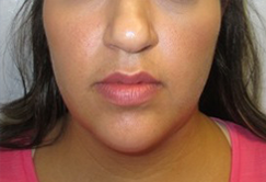 Neck Lift, Chin Liposuction before and after photo by Hughes Plastic Surgery in Los Angeles, CA