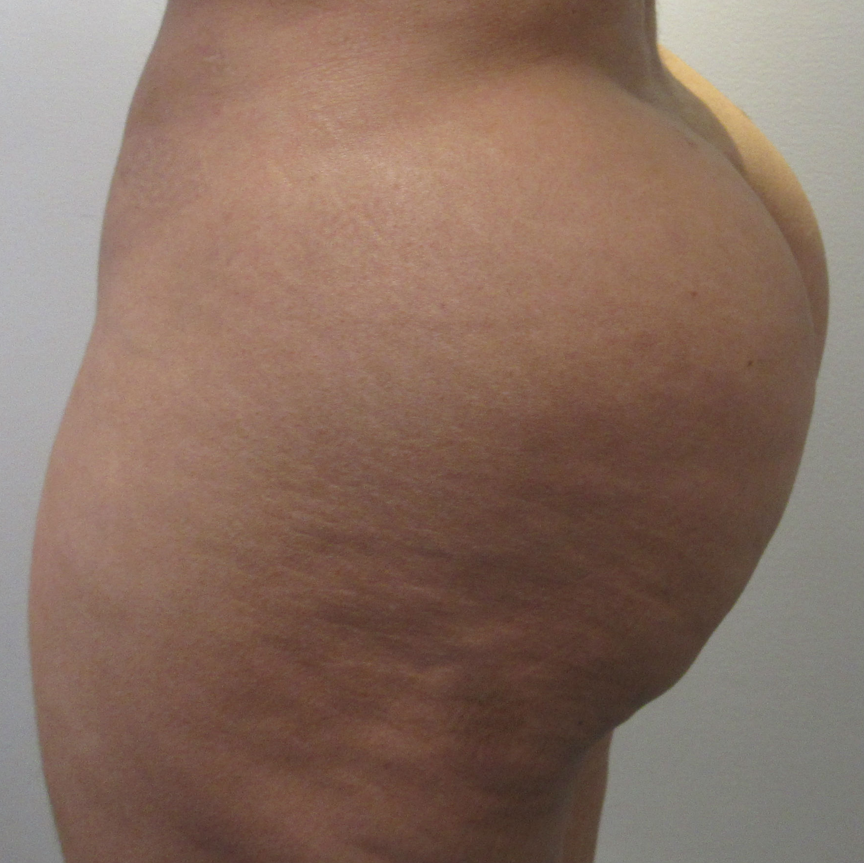 Butt Implants Case 8966 Before Photo