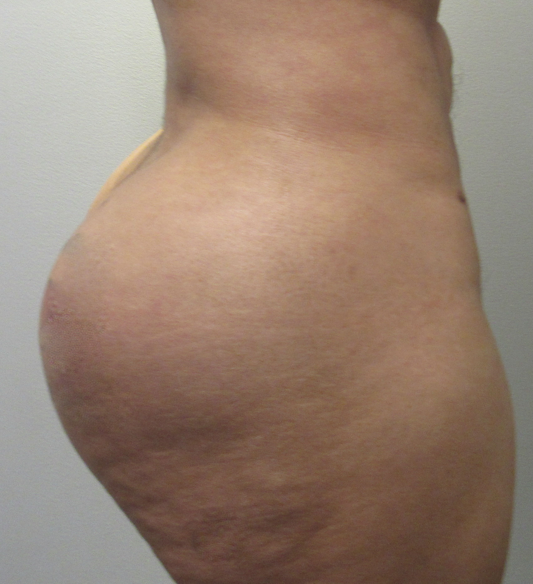Butt Implants Case 8969 Before Photo