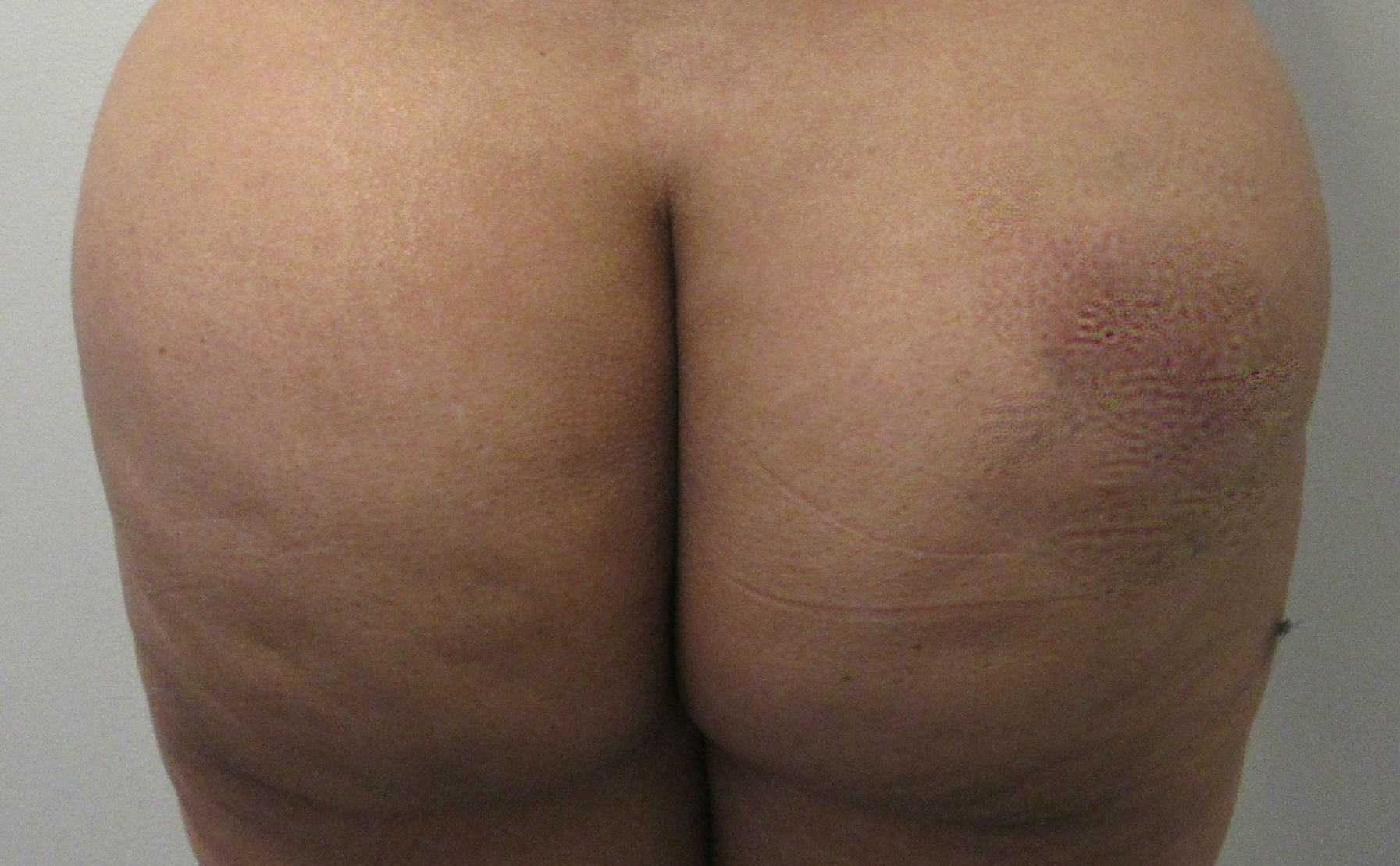 Butt Implants Case 8960 Before Photo
