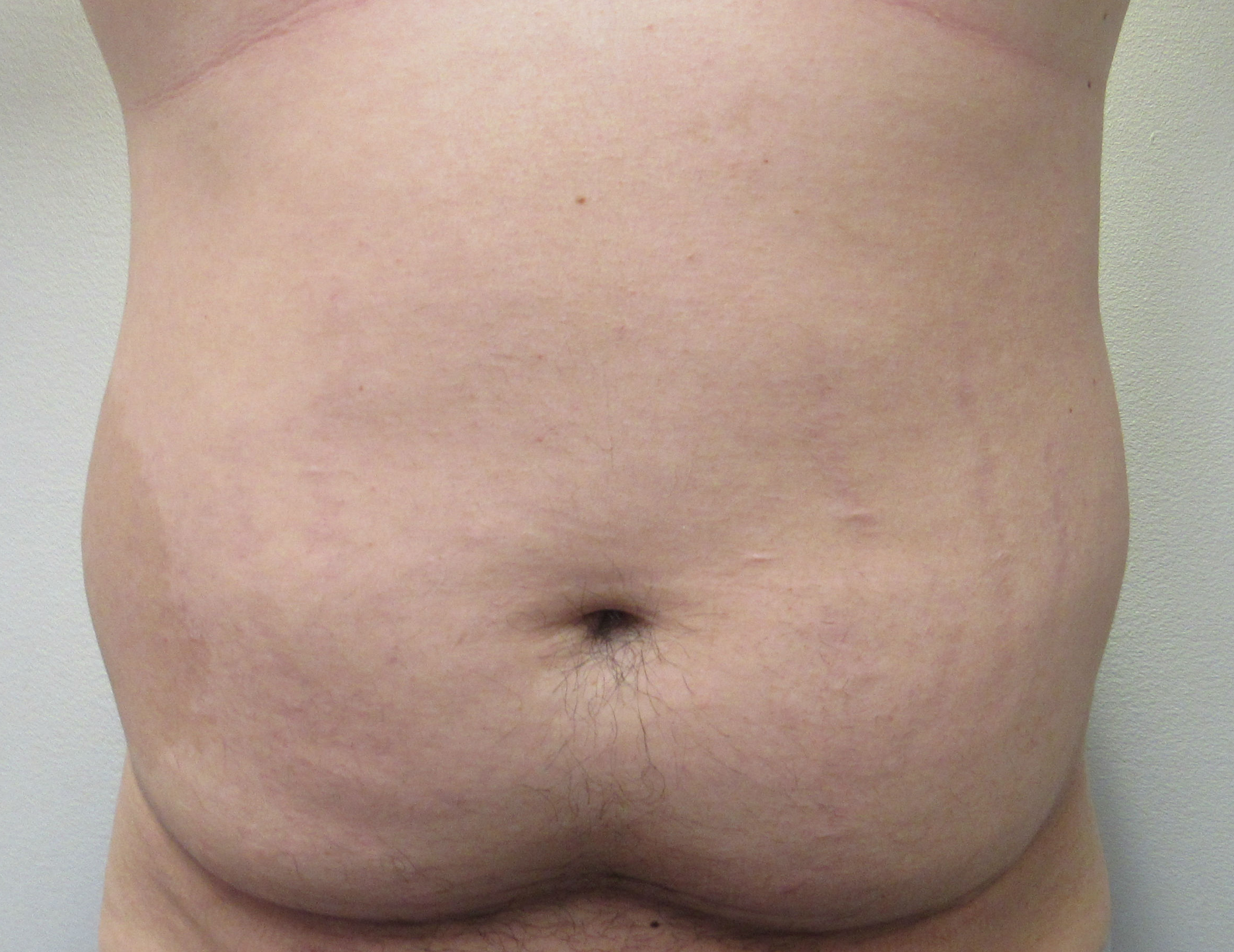 Male Liposuction before and after photos by Hughes Plastic Surgery in Los Angeles, CA