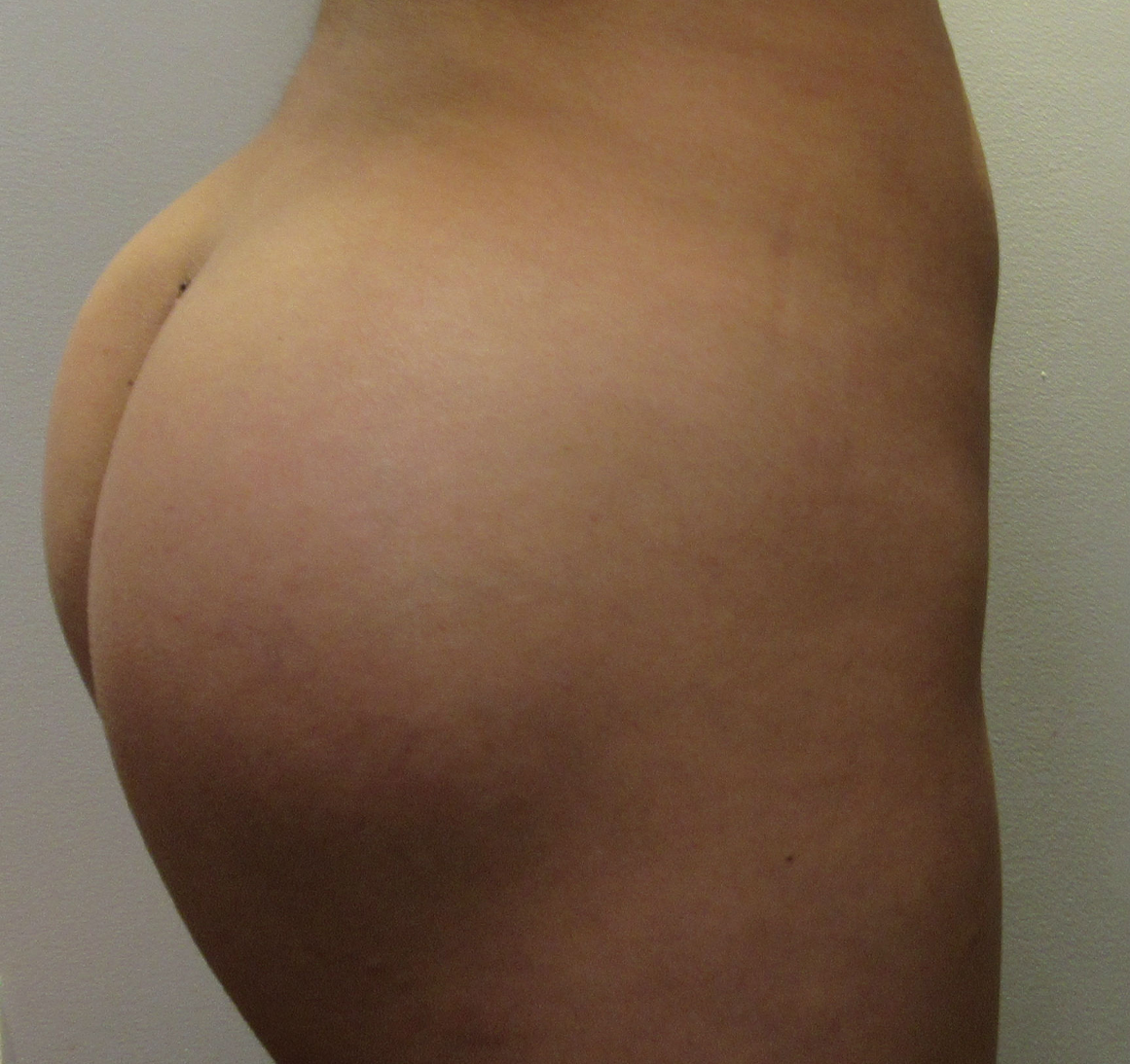 Butt Implants Case 9167 Photo