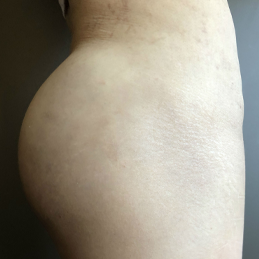 Butt Implants Case 9120 After Photo
