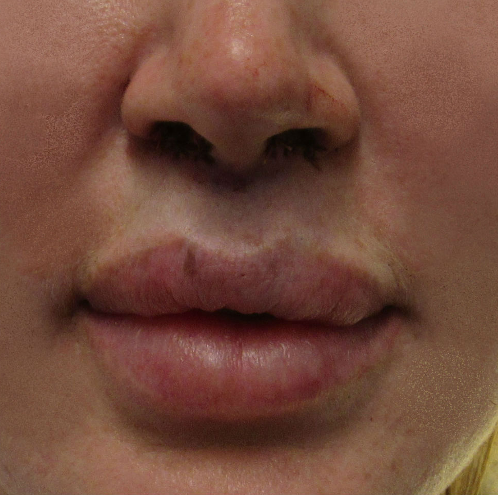 Lip Lift before and after photo by Hughes Plastic Surgery in Los Angeles, CA