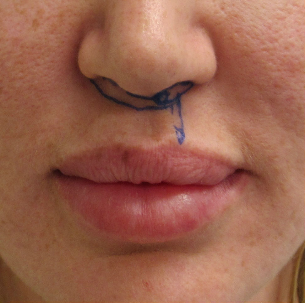 Lip Lift before and after photo by Hughes Plastic Surgery in Los Angeles, CA