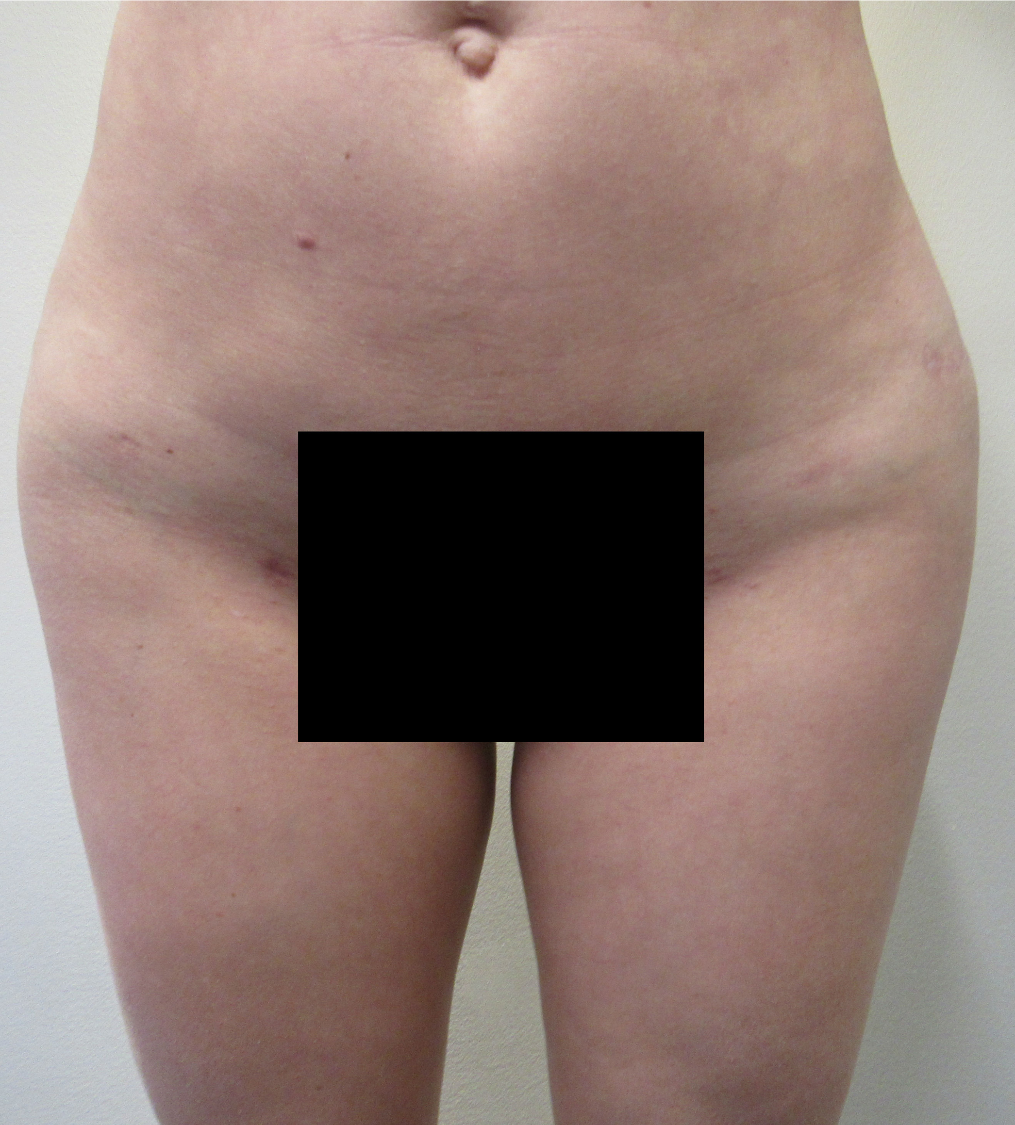 Butt Implants Case 9294 Before Photo