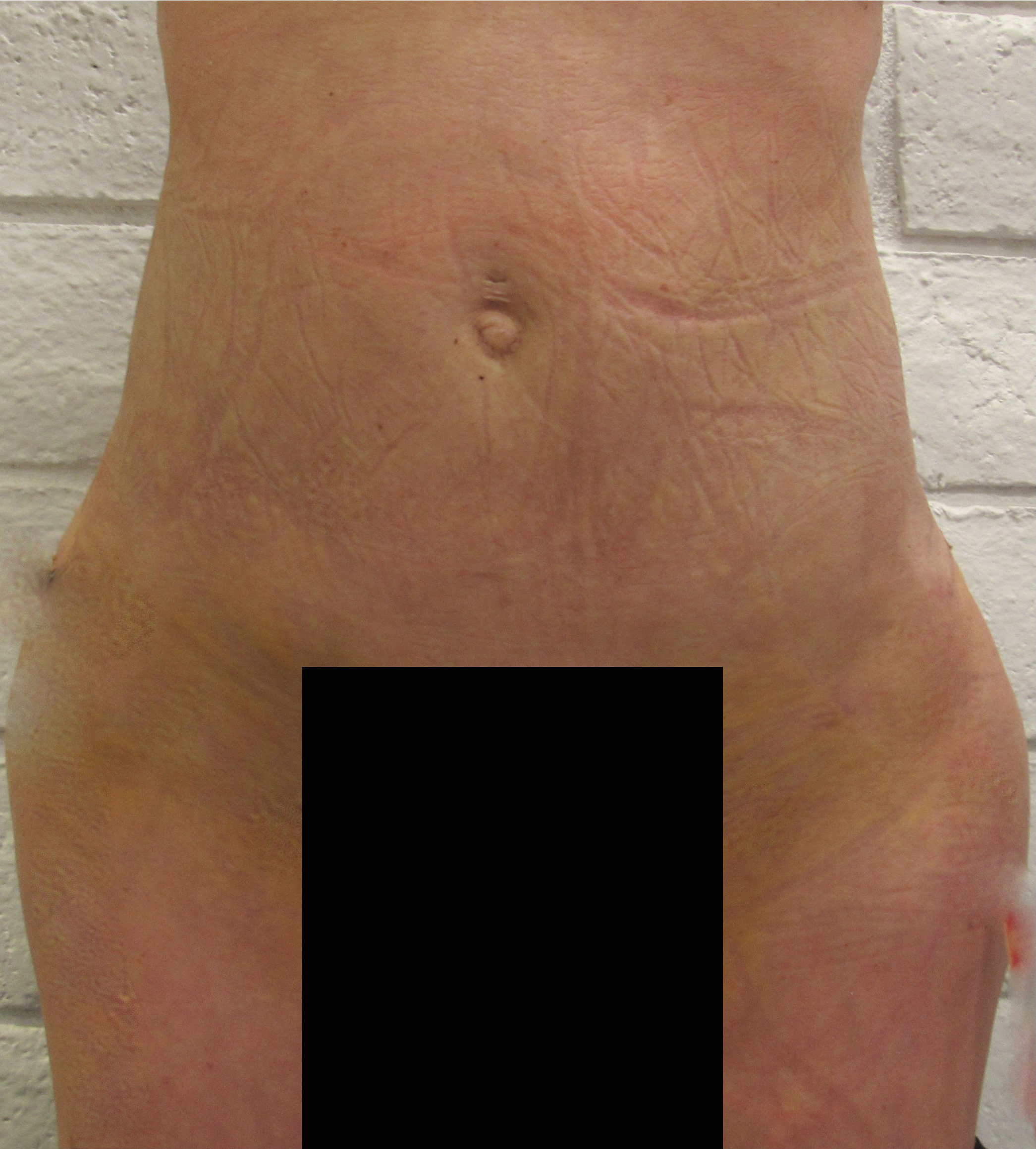 Butt Implants Case 9294 After Photo