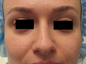Female Rhinoplasty Surgery before and after photos by Hughes Plastic Surgery in Los Angeles, CA