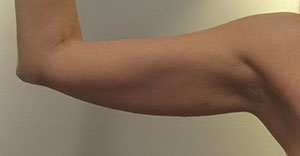 BodyTite, Arms before and after photo by Hughes Plastic Surgery in Los Angeles, CA